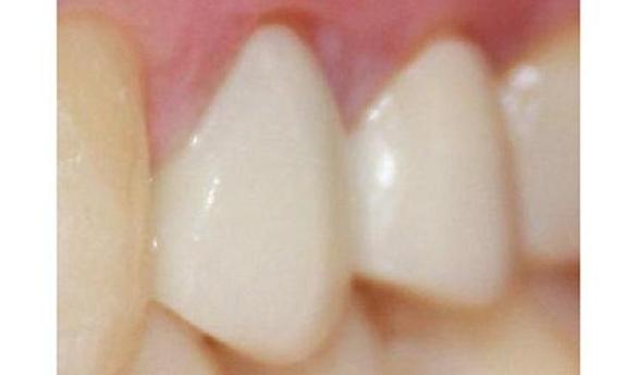 dental crown | cosmetic dentistry | vienna va 