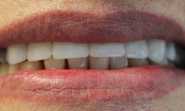 a set of teeth after dental crowns | dental crowns in vienna