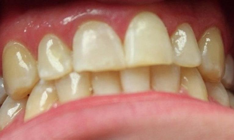 teeth that have had white spots removed after a resin infiltration | dentist in vienna va