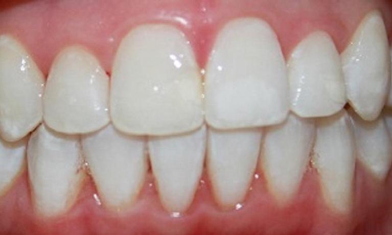 Resin-Infiltration-for-White-Spots-After-Image