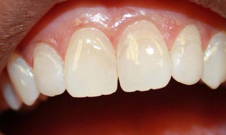 upper teeth with no white spots neat the gumline due to Resin Infiltration | cosmetic dentistry vienna va