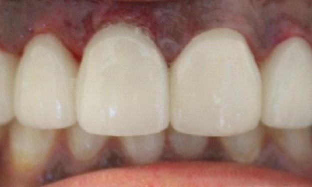 a mouth after veneers | dental veneers vienna va