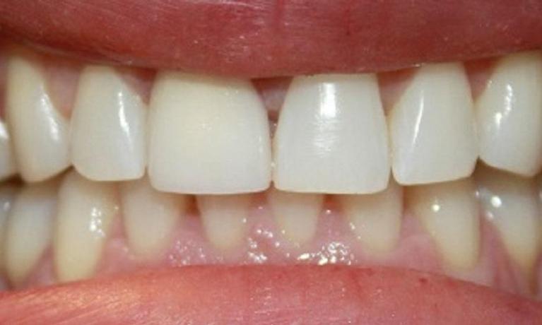 a patients two front teeth, newly shapen from veneers | dental veneers vienna va