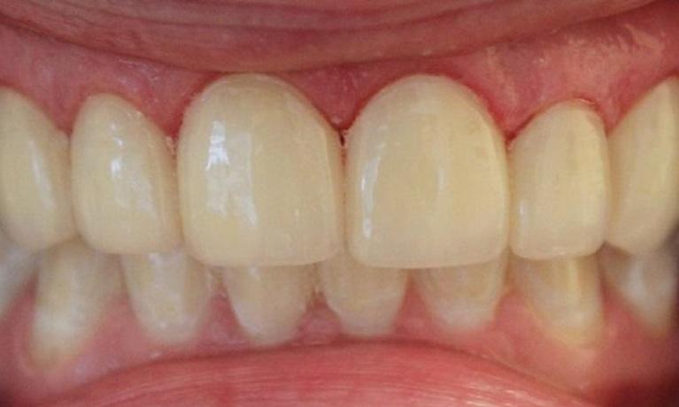 teeth after veneers | cosmetic dentist vienna