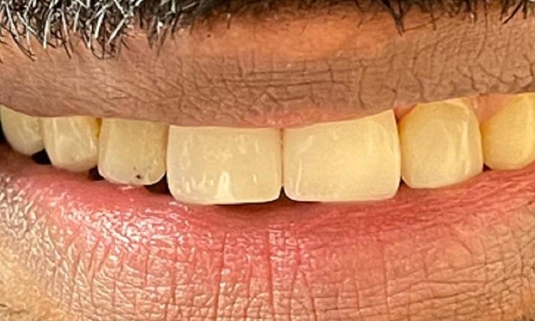 teeth after veneers at our office | vienna va dental veneers