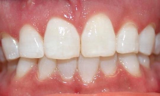 teeth after a Zoom! teeth whitening treatment | teeth whitening vienna va