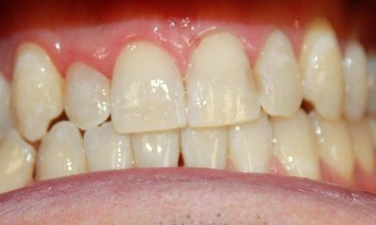 teeth after an in-office whitening treatment | in-office teeth whitening vienna va