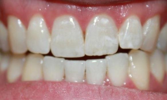 teeth after an in-office whitening procedure | professional teeth whitening dentist vienna va