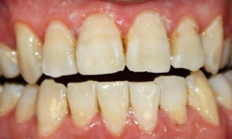 teeth after a resin infiltration 