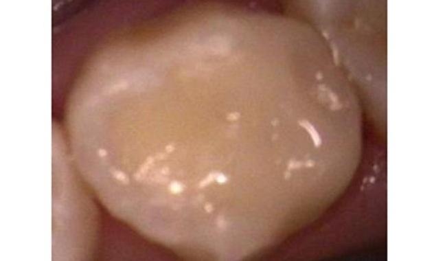 tooth colored filling | vienna va | tysons dentistry 