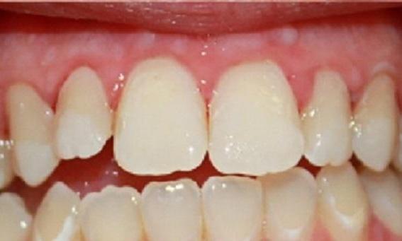 Resin-Infiltration-for-Dark-Spots-After-Image