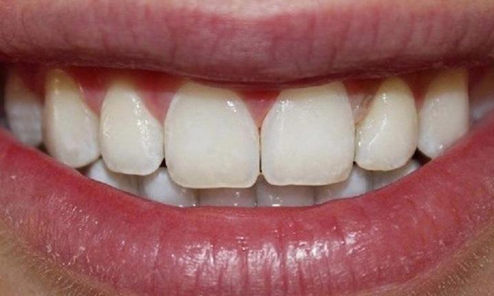 teeth after a resin infiltration treatment, with no white spots | cosmetic dentistry in vienna va