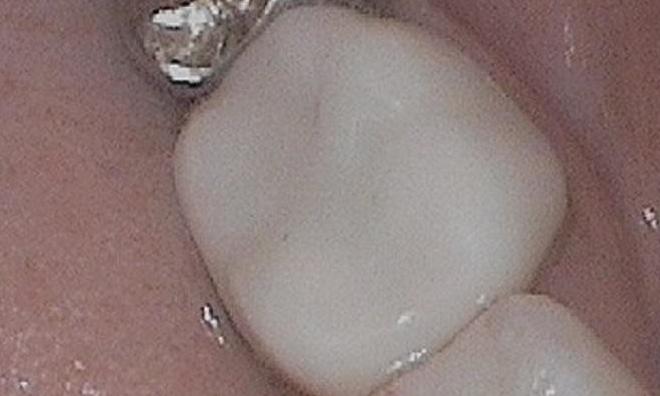 a tooth that used to have an amalgam filling, fixed with a tooth colored crown | dentist in vienna