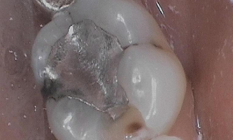 a molar featuring an old amalgam filling | dentist in vienna virginia