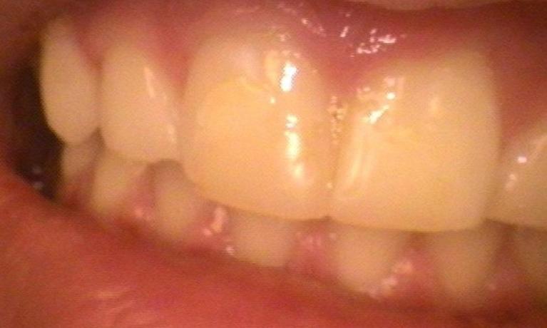 a front tooth with mismatched fillings | dentist in vienna