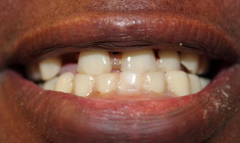 Complete-Dentures-Before-Image