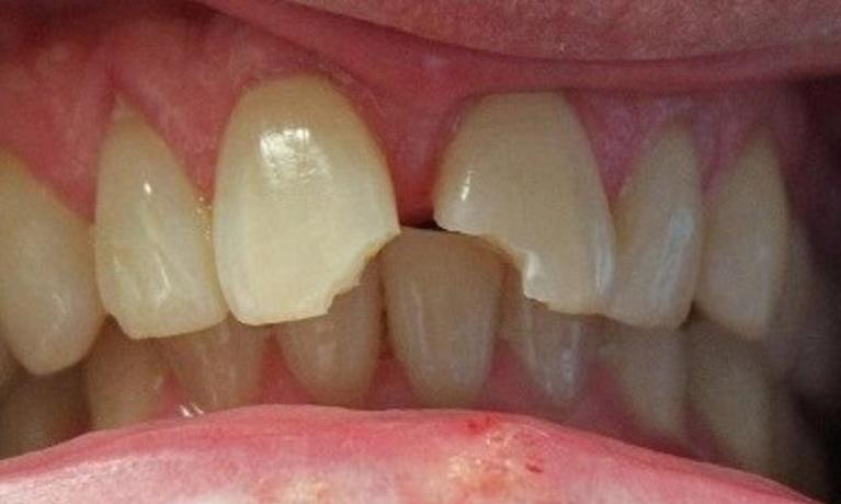 chipped and discolored front teeth | cosmetic dentist in vienna va