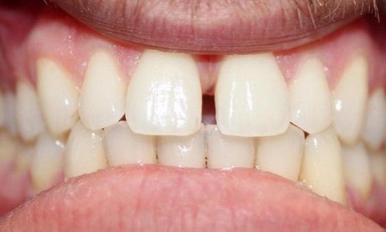 two front teeth with a gap and gum tissue between them | invisalign vienna va