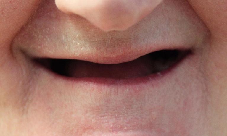 Hybrid-Dentures-Before-Image