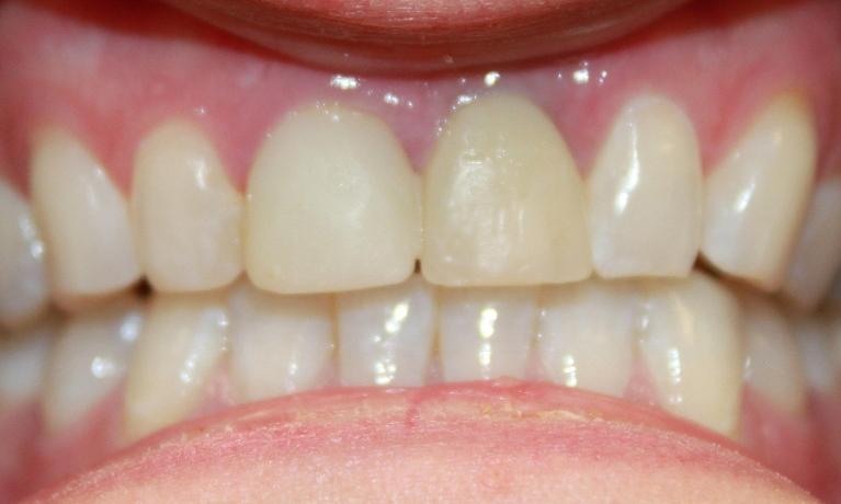 a patients mouth before an implant crown and a porcelain crown | dental implants vienna va