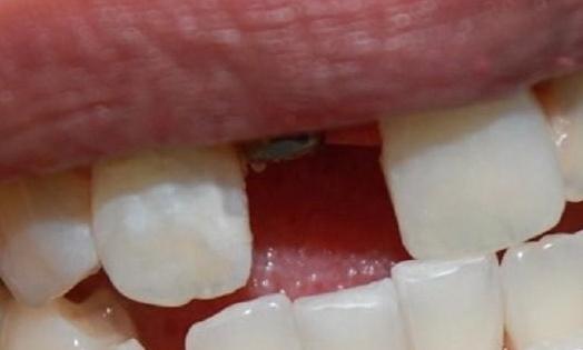 a non-crowned dental implant post | dental implants in vienna va