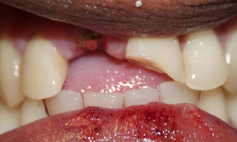 severely fractured front tooth (missing completely) | dental crowns vienna va