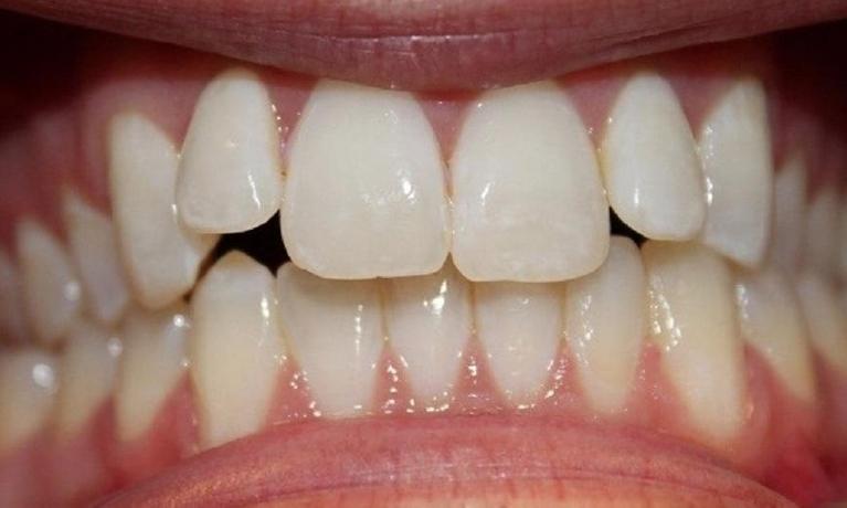 teeth before an invisalign treatment | invisalign vienna va