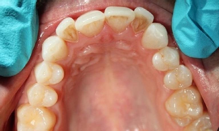 teeth before an invisalign treatment at our office | vienna va invisalign treatment