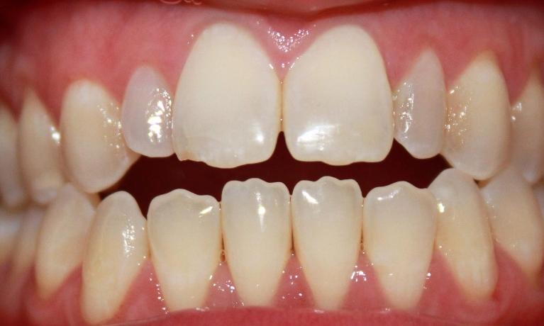 a patients mouth before invisalign | invisalign dentist vienna va