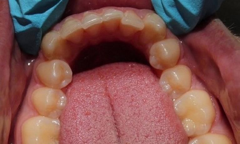 lower set of teeth before invisalign treatment | vienna invisalign dentist