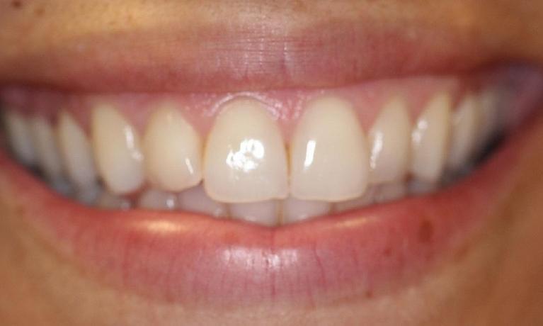 upper teeth before a KöR teeth whitening | dentist in vienna va