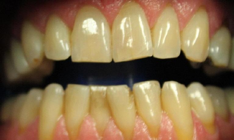 teeth before a laser whitening treatment | laser teeth whitening in vienna