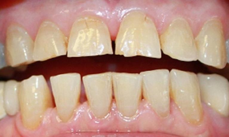 teeth before laser whitening and porcelain crowns from our vienna va office | dentist in vienna