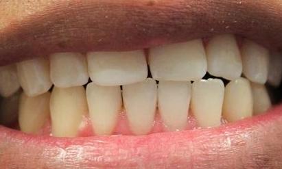 teeth before EPIC laser whitening | laser teeth whitening vienna va