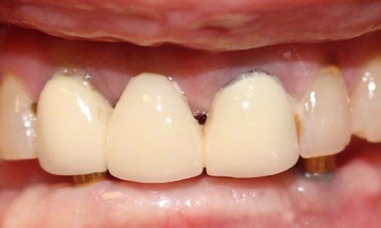 Overdenture-Before-Image