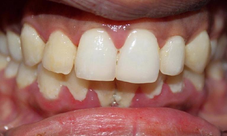 Periodontal-Treatment-Before-Image