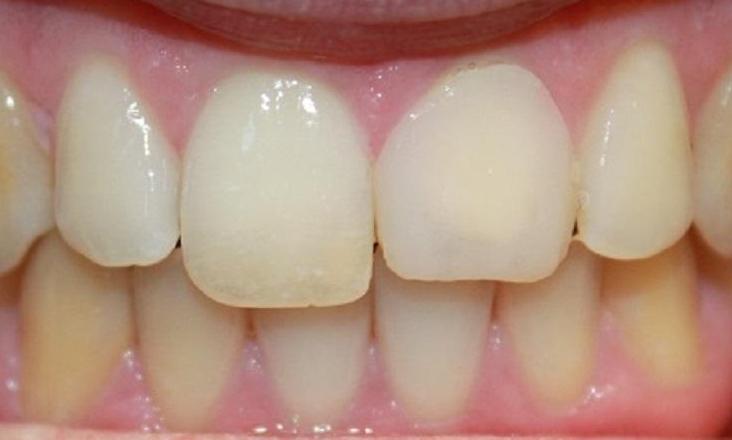 a front tooth before a porcelain crown | crowns in vienna va