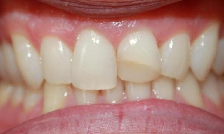 a chipped front tooth | dentist in vienna
