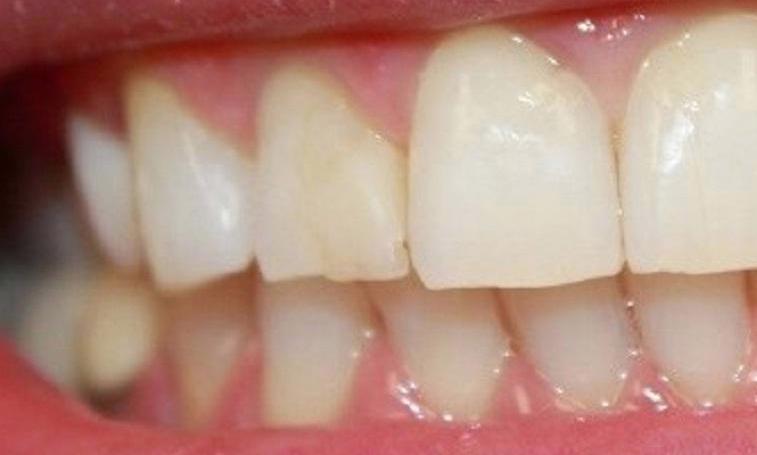 Porcelain-Crown-Before-Image