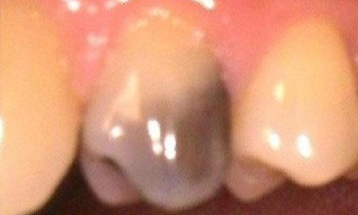 porcelain crown | dental crown | vienna va