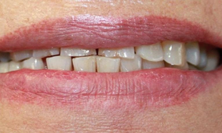 a set of teeth before crowns | dental crowns vienna va