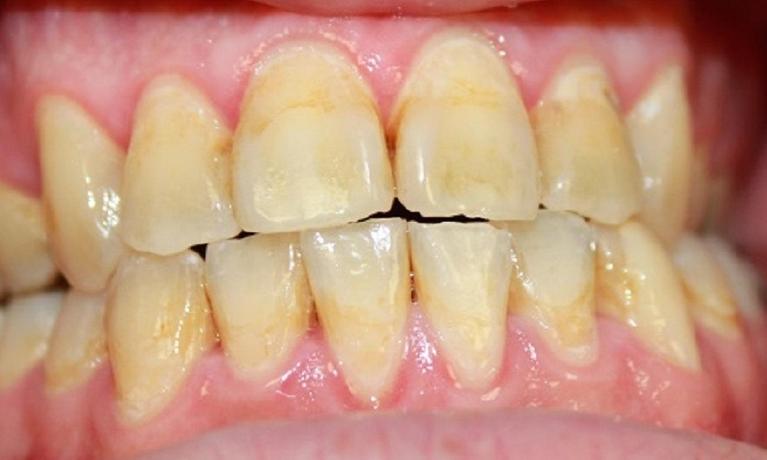 teeth before resin infiltration | dentist vienna va