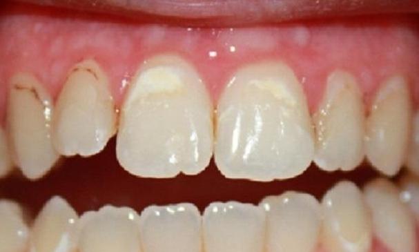 Resin-Infiltration-for-Dark-Spots-Before-Image