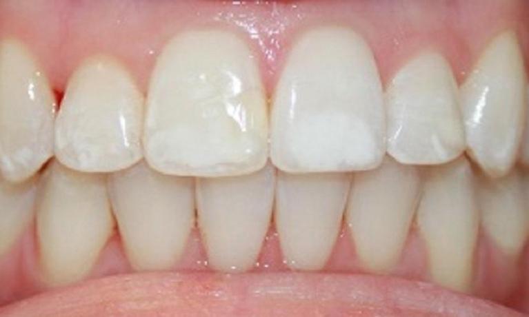 Resin-Infiltration-for-White-Spots-Before-Image