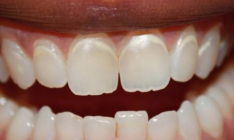 upper teeth with whitespots near the gumline | dentist vienna