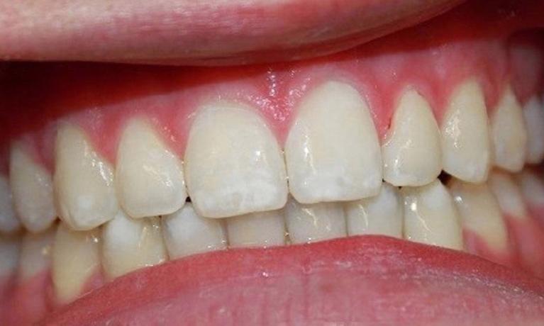 teeth containing white spots | resin infiltration dentist vienna va