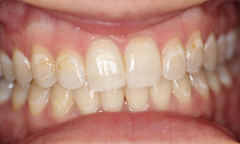 White spots on teeth after not brushing