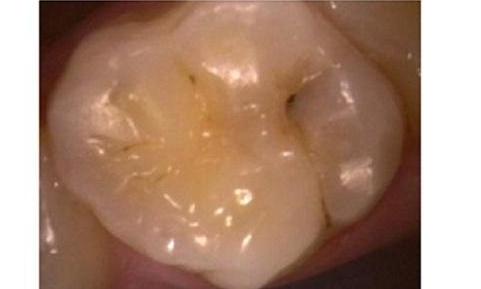 composite filling | dental fillings | vienna va