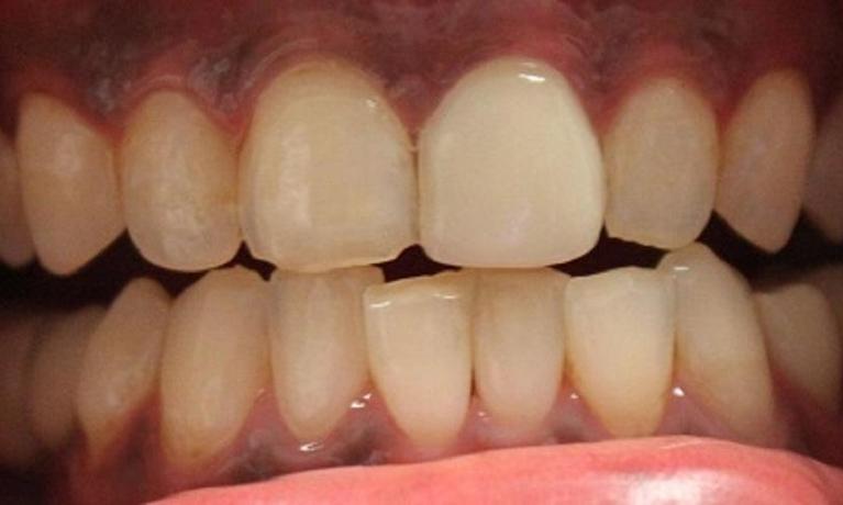 a mouth before veneers | dental veneers vienna