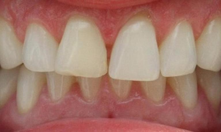 patients mouth before veneers | dental veneers vienna va